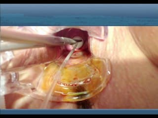 La trompe en échographie. Place de l’évaluation échographique de la perméabilité tubaire dans le bilan d’infertilité.