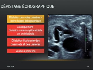REINS, VOIES URINAIRES, ORGANES GÉNITAUX EXTERNES  Reflux