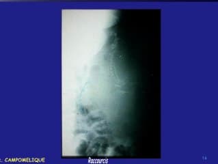 Fémurs courbes et courts