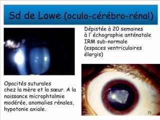 Anomalies oculaires dépistables en anténatal et prise en charge post-natale