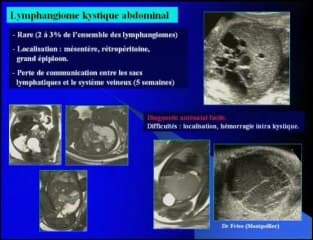 Kystes foetaux d'origine digestive