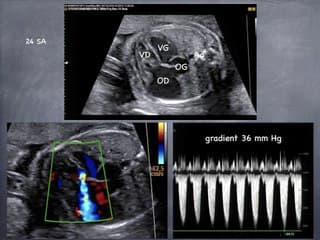 Atrésie pulmonaire: fonctionnelle ou organique?