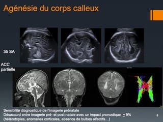 Dysgénésies du corps calleux Apport de l’IRM dans les anomalies du corps calleux.