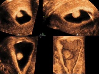 Place de l’hystérosonographie 2D – 3D dans la pathologie de la cavité