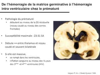 Hémorragies intraventriculaires du 3ème T : un pronostic comparable à celles du prématuré ?