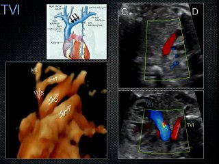 L' examen du coeur Ce qui est trop souvent oublié lors de l'examen de routine : Situs et VCI, axe du coeur, sinus coronaire, foramen ovale :