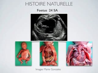 Annonce du diagnostic de l'anomalie d'Ebstein la persistance d'un dilemme pour le cardiologue
