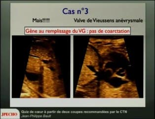 Quiz de coeur à partir de deux coupes recommandées par le CTN