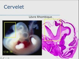 Anomalies de la ligne médiane, au-delà du corps calleux : embryologie