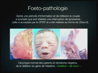 Diagnostic anténatal d'un syndrome de Williams Beuren.
