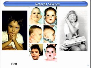 Place de la T21 parmi les maladies génétiques de l’intelligence (Xfra, 1p36, 22q11, disomies uniparentales, cri du chat, Williams-Beuren, Smith-Magenis)