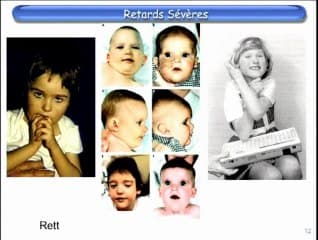 Place de la T21 parmi les maladies génétiques de l’intelligence (Xfra, 1p36, 22q11, disomies uniparentales, cri du chat, Williams-Beuren, Smith-Magenis)