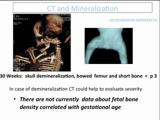 scanner er IRM pour l' étude de l' os foetal  ( en ANGLAIS )