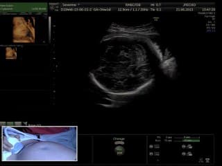 Live: échographie et accouchement