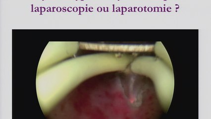 Fibromes : nouvelles stratégies Traitement des fibromes de type 3