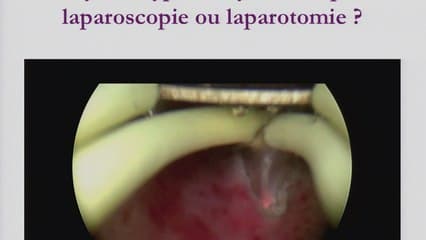 Fibromes : nouvelles stratégies Traitement des fibromes de type 3