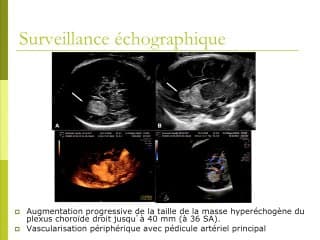 Elastographie cérébrale foetale : une aide au diagnostic prénatal d'un papillome du plexus choroide.