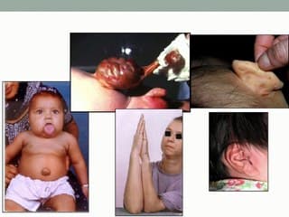 Complications périnatales du Syndrome de Beckwith-Wiedemann : données obstétricales et néonatales d'une série rétrospective de 84 patients sur la région Grand Ouest