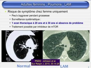 Les Centres de référence Maladies Rares :  Sclérose Tubéreuse de Bourneville
