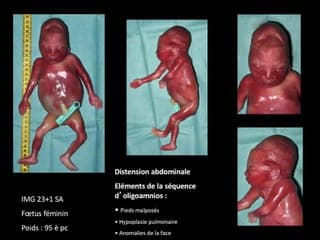 Néphropathies: cas cliniques polykystose …