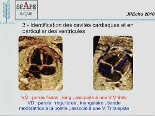 transposition des gros vaisseaux