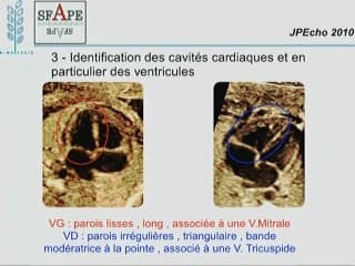 transposition des gros vaisseaux