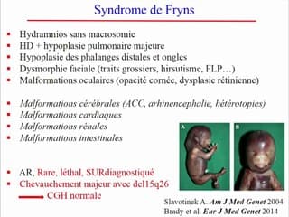 Hernie diaphragmatique : Enquête génétique en cas de découverte d'une hernie diaphragmatique