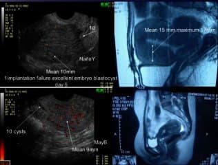 Nouveaux signes échographiques (+/-IRM) pour le diagnostic de l'adénomyose utérine chez la patiente infertile