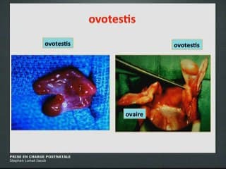 Anomalies des organes génitaux externe : Prise en charge postnatale