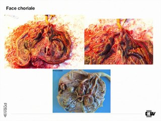 la dysplasie mesenchymateuse du placenta