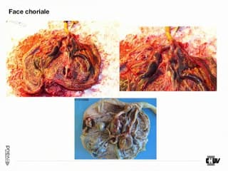 la dysplasie mesenchymateuse du placenta
