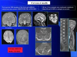 L’IRM post mortem ou l’autopsie virtuelle