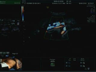 Live Placenta 3ème trimestre et cordon