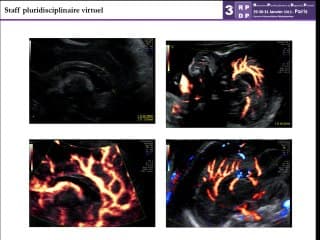 Agénésie du corps calleux
