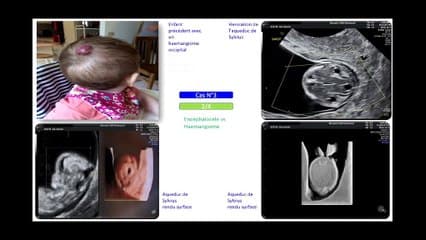 1er Trimestre Détection précoce des anomalies fœtales