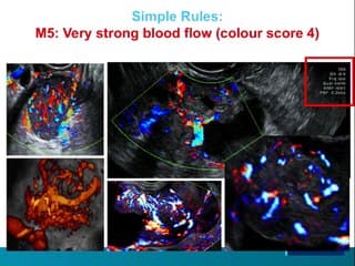Classification des masses ovariennes iota