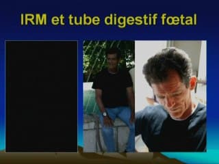 Le tube digestif foetal : 2 ans plus tard