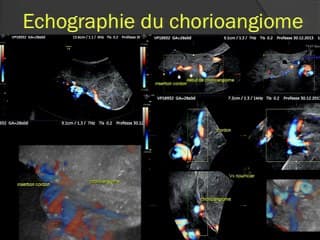 Prise en charge par laser d'un chorioangiome avec anasarque : à propos d'un cas
