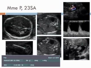 Conduite à tenir devant une hyperéchogénicité intestinale foetale