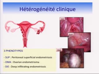 Echographie dans l'endométriose : Images, signification et conséquences