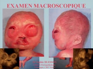 Exophtalmie particulière : cherchez les yeux.