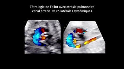 TGV et anomalie des gros vaisseaux