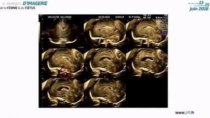 Thrombose du torcular