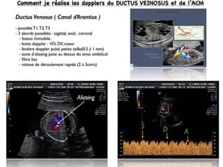 POSTER Doppler Ductus-ACM