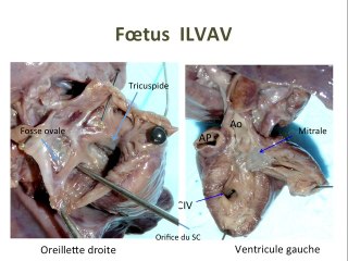 ILVAV et T21