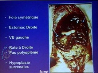 Les signes d'appels des hétérotaxies (anat patho)