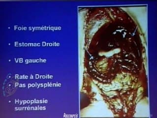 Les signes d'appels des hétérotaxies (anat patho)