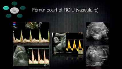 Quelle conduite donner à l’examen échographique devant un fémur court