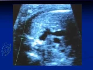 Anévrisme du canal artériel