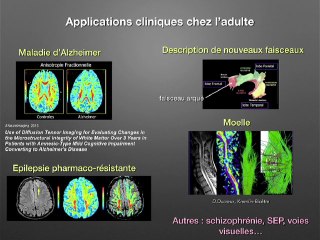 Quels signes échographiques doivent faire penser à demander une analyse IRM par tractographie?